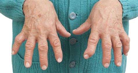 parmakların artroz artriti, eklemlerin etkilediği fark